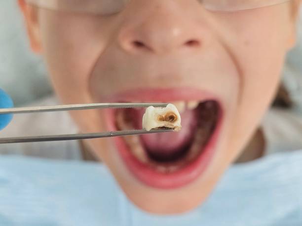 Best Broken or Cracked Tooth Emergency Dentist in Brooklyn, IN
